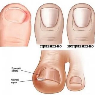 Онихокриптоз или вросший ноготь у ребенка.